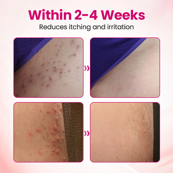 Cpviat® IntiDefend Anti-HPV Interferon Gel